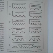 ça se rapproche de la denture perroquet